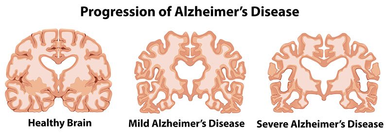 alzheimers-brain.jpg