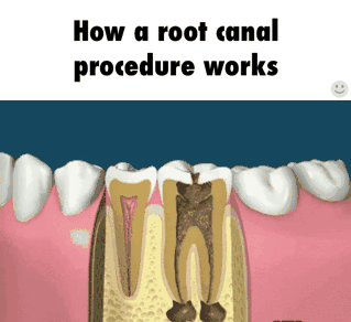 root_canal_gif.gif