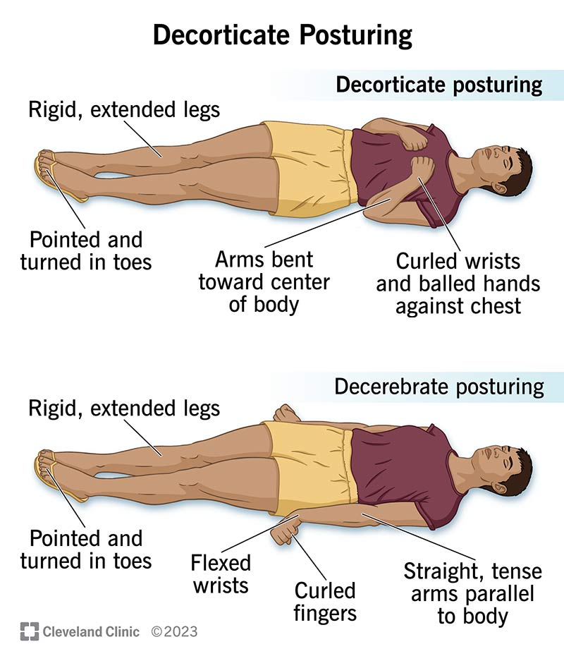 24969-decorticate-posturing