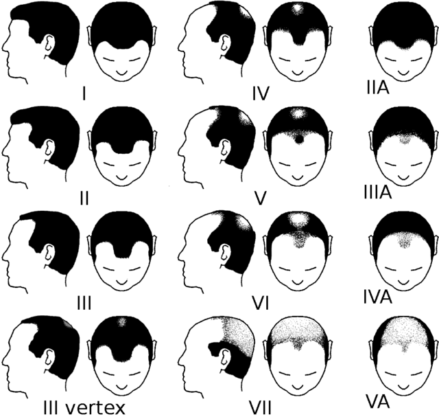 640px-Partial_Norwood_scale_for_male_pattern_baldness.png